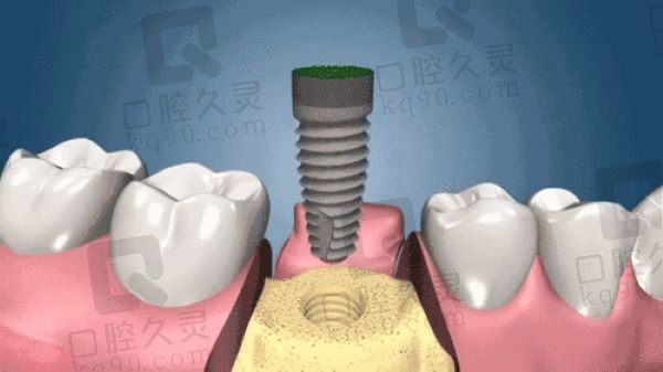 南京晶齿丽口腔医院美国皓圣种植牙3980元起，修复缺牙美观逼真