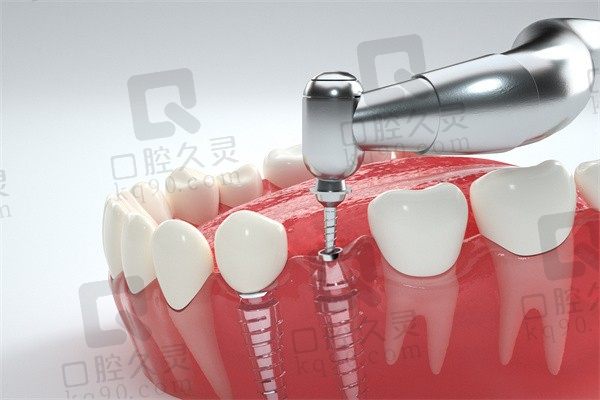 邢台牙博士口腔T-Plus种植牙2980元起，瑞士品牌质量好