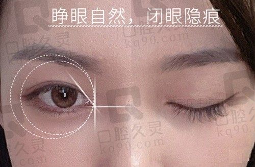 北京眼修复认准丰联丽格,谁让师丽丽双眼皮修复成功概率大案例多呢