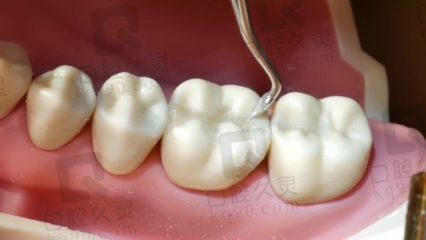 北京禾禾口腔进口3M树脂补牙469元起，美观自然又耐磨耐用
