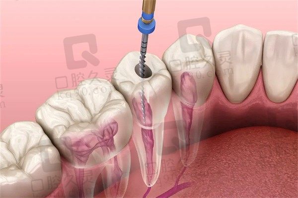 根管后戴牙冠是忽悠你吗？求问根管治疗后不戴牙冠可以吗