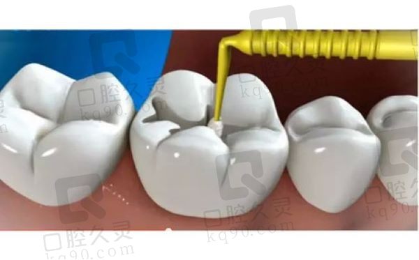 厦门登特口腔3MP60树脂补牙145元起，坚硬耐磨色泽美观