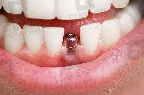哈尔滨优诺口腔种植牙价格:单颗2480-9800元,半全口19000-80000元