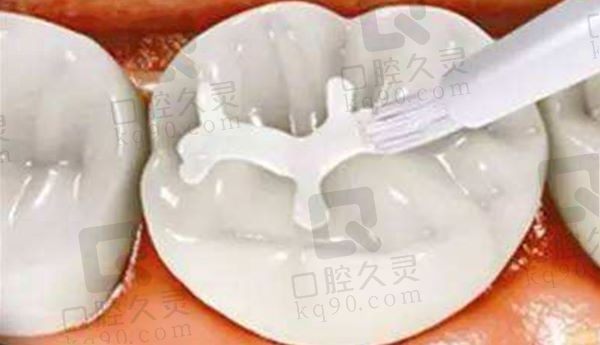 潍坊华贝口腔医院3MP60补牙289元起，硬度高色泽自然和真牙一样