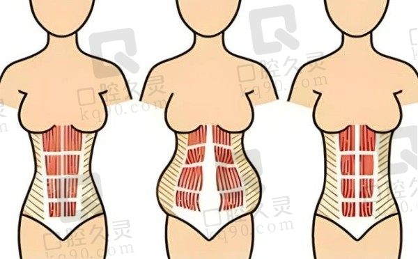 成都张航做腹壁怎么样?擅长腹壁整形+乳房悬吊解决产后胸下垂腹部松弛