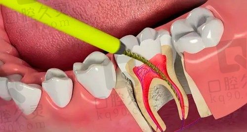 诸暨复大口腔后牙根管治疗768元起一颗，解决牙齿疼痛问题