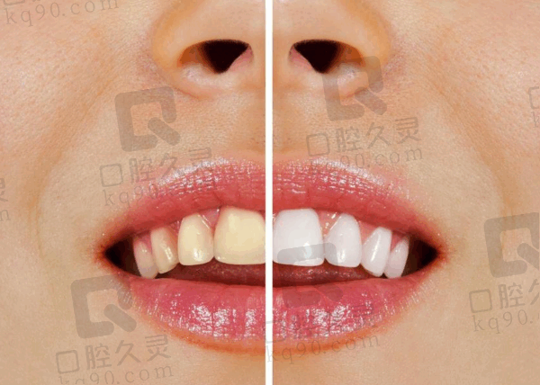 武汉咿呀口腔Emax瓷贴面979元起，美白舒适又自然