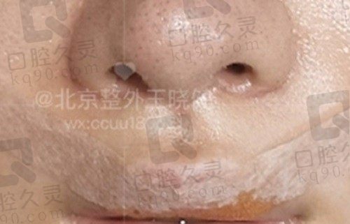 北京王晓健人中缩短失败了?扯淡!王晓健人中缩短做得好从未失败