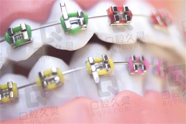 矫正过的牙齿反弹了怎么办？太久没戴保持器后强行带上有用吗