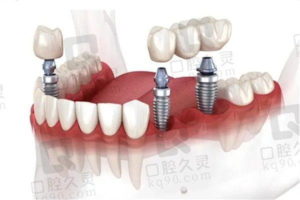 种植牙体韩国,美国,瑞士哪个好？经过多方对比确实有区别
