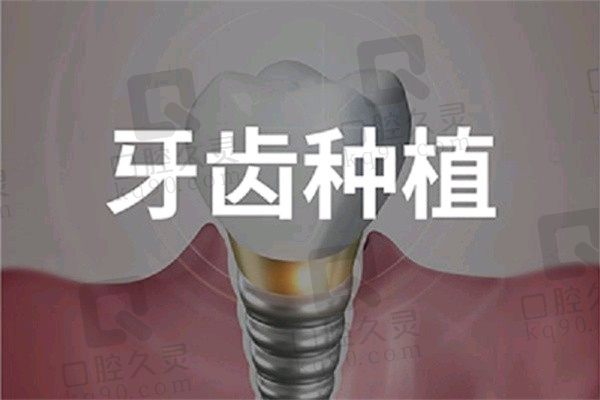 嵊州鼎植口腔冯永康韩国NEO种植牙2680元起，性价比超绝
