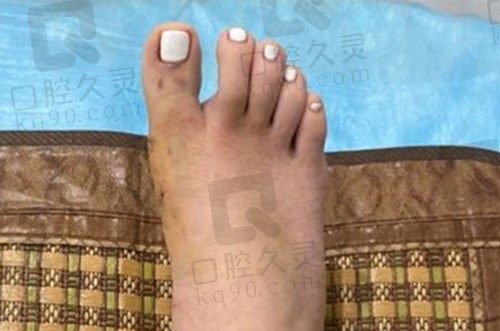 北京大脚骨医院推荐北京圣嘉新~有苏敬达坐诊,大脚骨技术水平极高