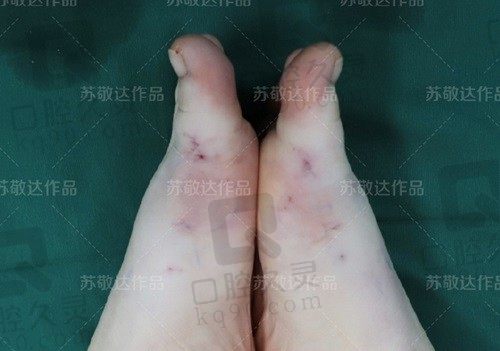 北京大脚骨医生苏敬达简介：擅长微孔治疗拇外翻价格只有9800元起