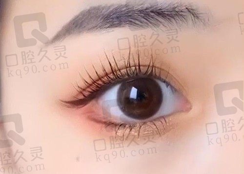 郑州正美医疗美容双眼皮价格:青春定格重睑术4-8K/兰格急速重睑术8-15K