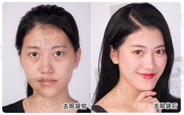郑大二附院杨丽修复眼袋吗?杨丽修复眼袋水平高价格不贵