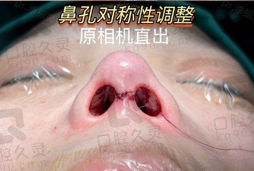 北京米扬丽格巫文山院长做鼻子怎么样?很强,有6项鼻整形专利技术