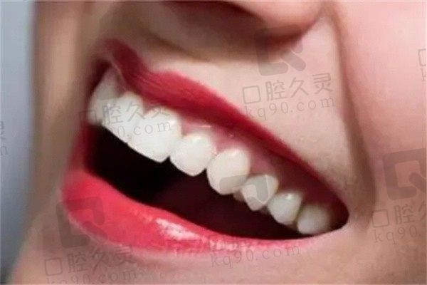 广州柏德口腔牙齿冷光美白价格500元起，过程舒适成效出色