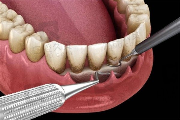 广州柏德口腔全口牙周刮治1.6K起，治疗牙周炎、固定松动牙