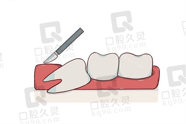 南宁牙博士口腔拔智齿价格348元起，丘家泉医生拔智齿经验足