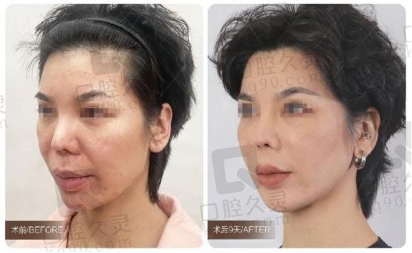 北京煤医陶泓旭馒化修复技术好,实力派医生专注面部馒化修复成效自然