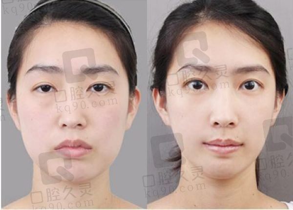 合肥卫爱侠双眼皮修复怎么样？价格实惠医生审美在线风格自然