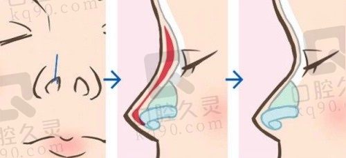 杭州项昌峰做鼻子怎么样?20年经验+自然风案例+真人反馈,超详细测评!