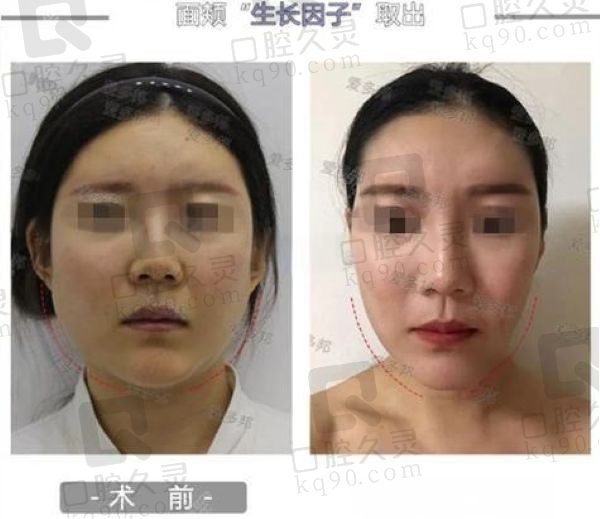 广州市荔湾中心医院异物取出多少钱？价格表+技术优势+医生推荐