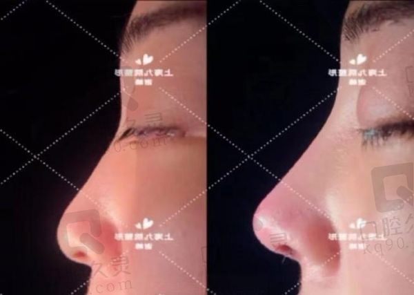 军美章小平隆鼻效果怎么样?效果明显审美出众风格自然收费合理