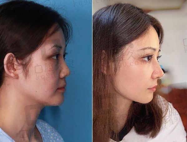 重庆军美谭焰红医生什么时候在军美坐诊?预约方式+鼻修复价格揭晓