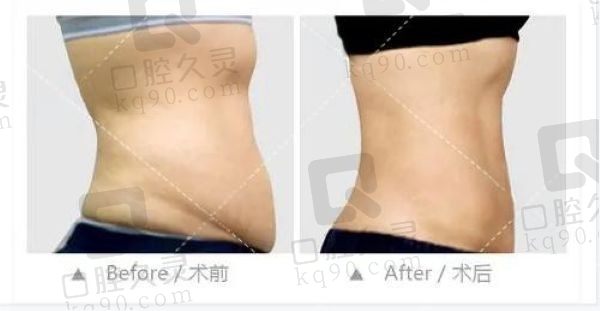 重庆刘彦龙吸脂效果怎么样？成效很明显附真实案例口碑好性价比高