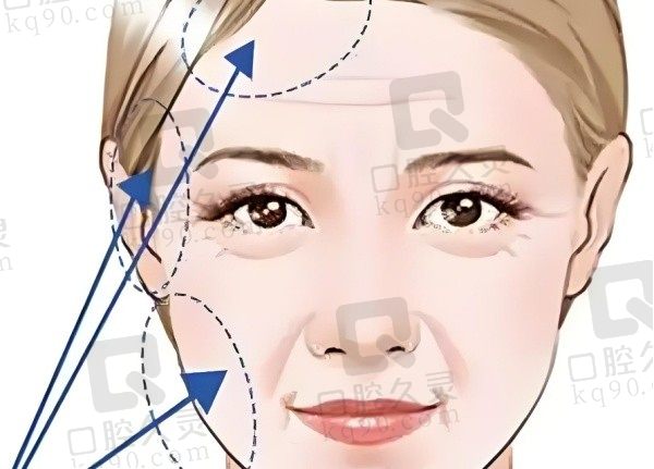 风筝小拉皮手术也属于线雕吗？风筝小拉皮怎么做？能维持多久？