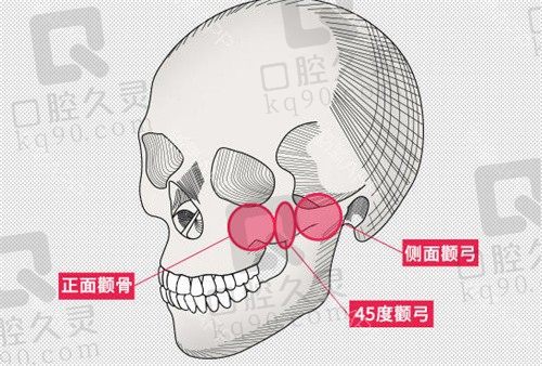广州柳超颧骨做的怎么样?柳超做颧骨内推很拿手且风格自然口碑好放心预约