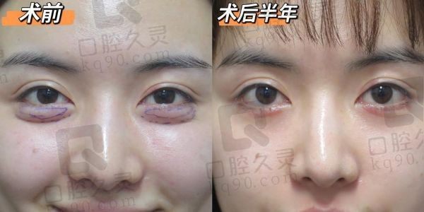 贺洁眼外翻一般要多少钱？贺洁眼睑外翻技术好案例多口碑评价高