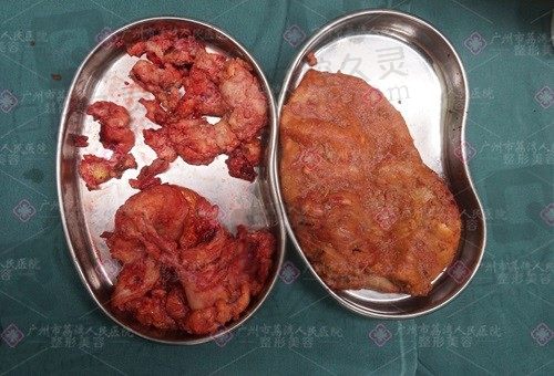 广州荔医清奥馒化脸修复全息6维层离清奥术3.0，分型精准逐层消除