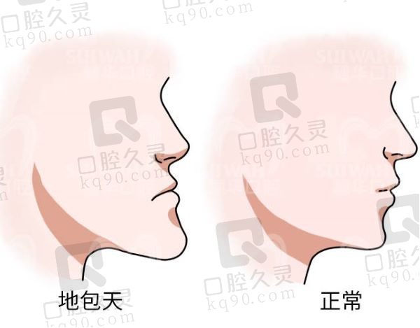 广州广大何锦泉地包天价格+技术优势+真实案例公布，地包天矫正必看