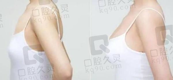 陈成医生在隆胸中是什么水平？属于国内隆胸医生排名前十的水平