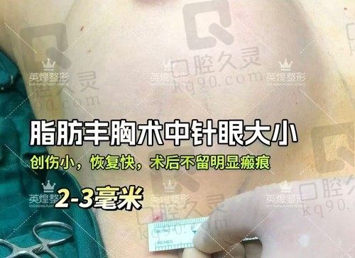 北京英煌脂肪丰胸怎么样？间联祖细胞丰胸优势多多,一次手术罩杯飞跃