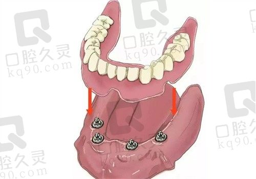石家庄植美口腔种牙技术怎么样？院内有靠谱医生坐诊种牙技术好且价格不贵
