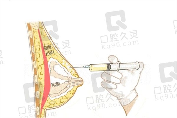 北京英煌自体脂肪隆胸价格32800元起，形态立挺手感Q弹
