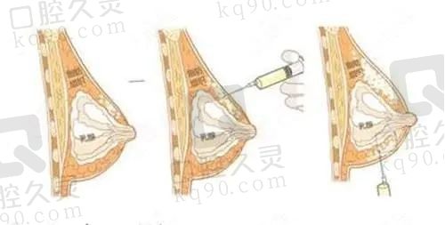 商洛自体脂肪填充丰胸的医院哪家好？医院信息+价格全都有
