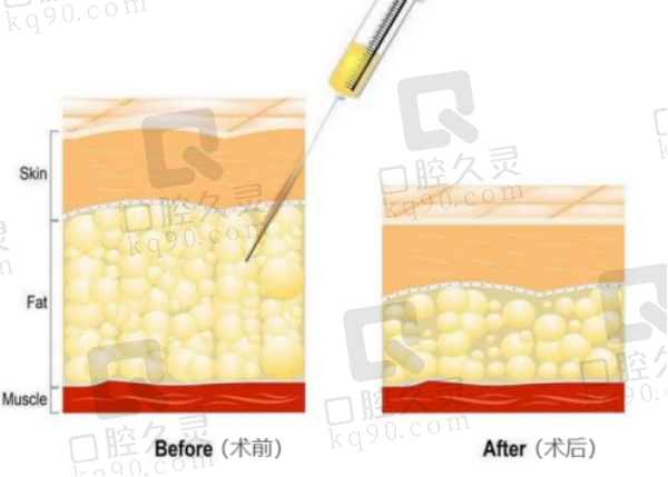 上海何斌抽脂技術(shù)怎么樣?吸脂成效自然&口碑在線,附真實案例對比