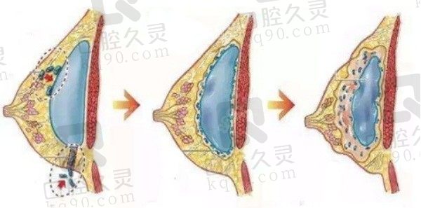 乳房注射物取出是几级手术？属于二级手术,一般3-6个月后彻底恢复