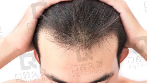 东莞正规植发医院哪家技术好？这几家都是植发技术好口碑不错的医院