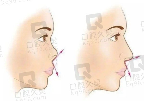 范荣杰鼻子属于几线档次？国内一线鼻修复医生做挛缩鼻修复案例多