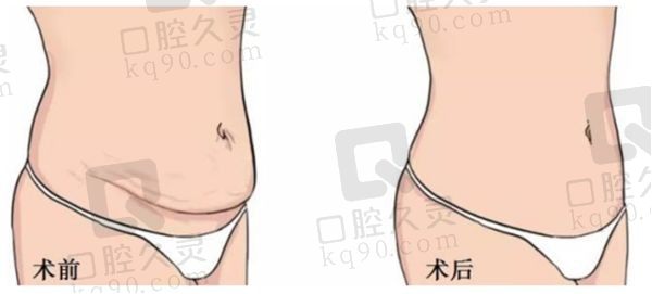潘红伟吸脂算第几名？技术和名气排前三,成都潘红伟抽脂/口碑与评价一览