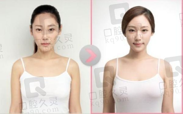 卫爱侠医生做脂肪丰胸口碑怎么样？口碑爆棚附顾客真实案例