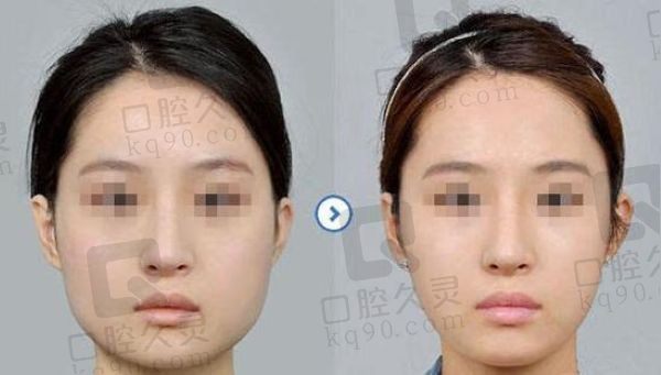 沈绍勇磨骨属于什么档次？高端档次,他的7d榫卯技术改脸型非常出名