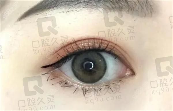 王冀耕内眼角修复怎么样？技术优势+真实案例+价格解析