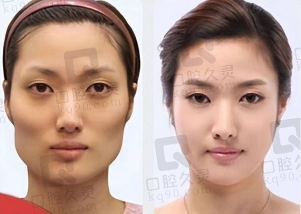 李志海磨骨手术好吗？成效好风格自然成功案例比较多价格也不贵