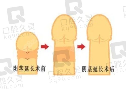 李世荣教授阴茎延长增长手术价格6.8-8.8W，让男人开始重振雄风